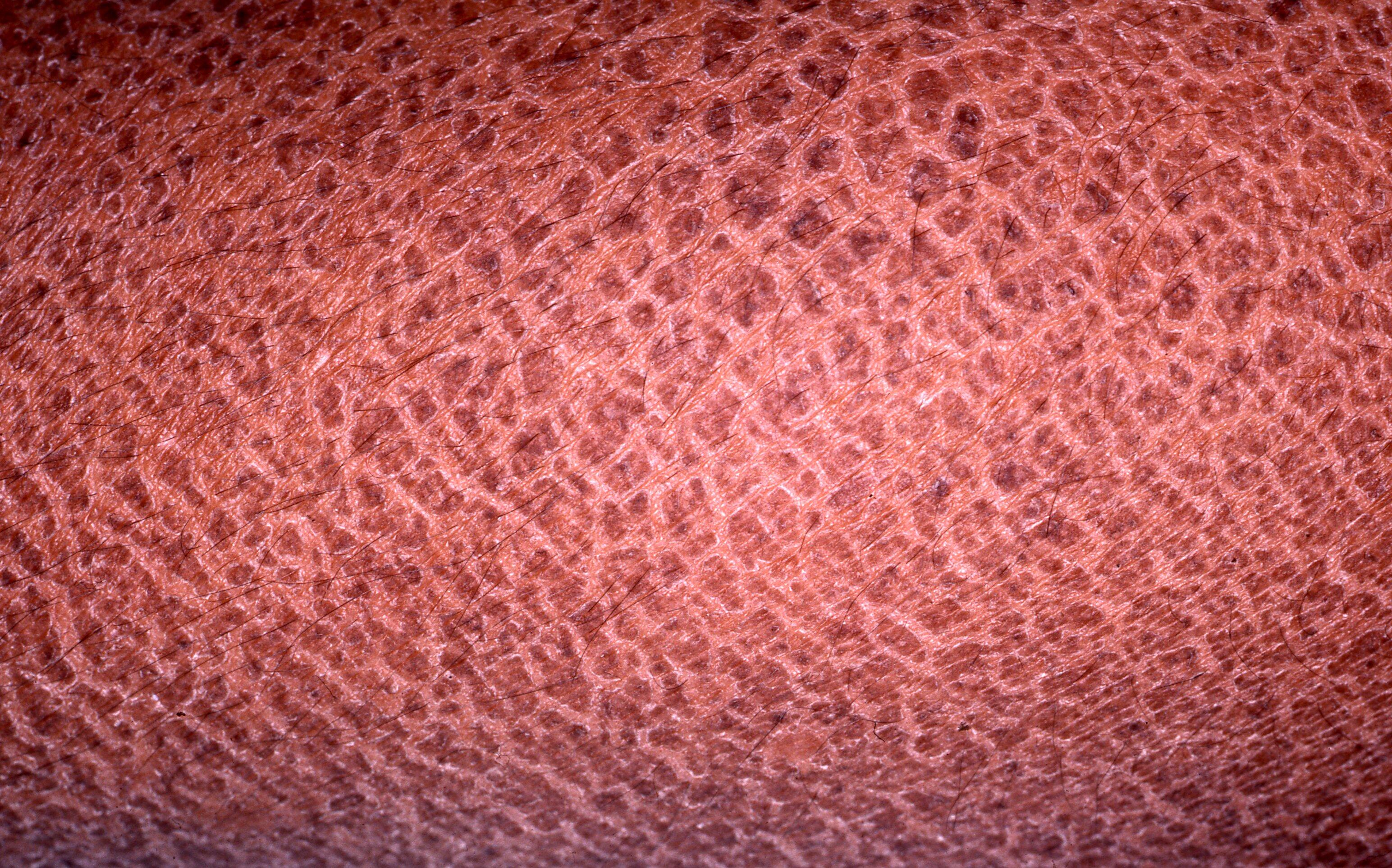 
            md_dexeryl_website-ichthyosis-image-xri_dermweb
        